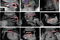 Inteligența artificială în ecografia fetală: depistarea precoce a anomaliilor (Pattern Recognition and Anomaly Detection in Fetal Morphology Using Deep Learning and Statistical Learning (PARADISE))
