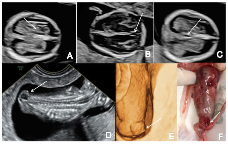 Depistarea precoce a anomaliilor fetale la ecografia de trimestru I (First Trimester Ultrasound Detection of Fetal Central Nervous System Anomalies)