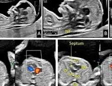 Depistarea malformațiilor cardiace fetale încă din primul trimestru (Confirmation of Heart Malformations in Fetuses in the First Trimester Using Three-Dimensional Histologic Autopsy)
