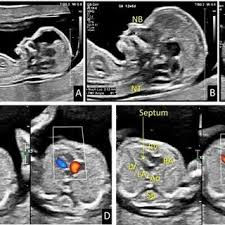 Depistarea malformațiilor cardiace fetale încă din primul trimestru (Confirmation of Heart Malformations in Fetuses in the First Trimester Using Three-Dimensional Histologic Autopsy)