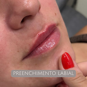 PREENCHIMENTO LABIAL (1).jpg