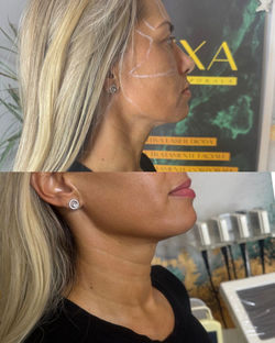 Tratament HIFU pentru lifting facial și corporal