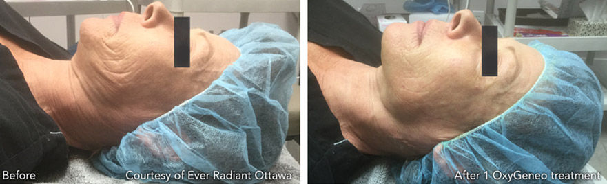 before-and-after-oxygeneo
