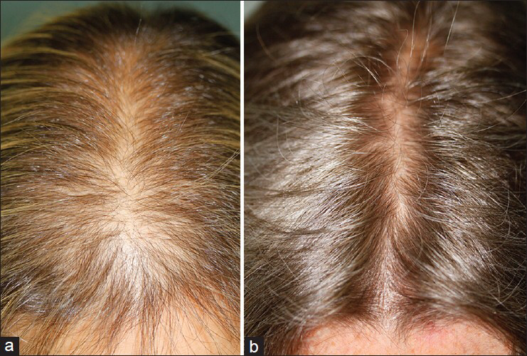 microneedling-hairloss1-copy