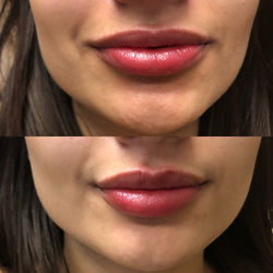 ParisPlump.Lips.Filler.Scottsdale.AZ.Beforeandafter.ParisInjectables.20