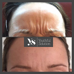 frown b&a.jpeg