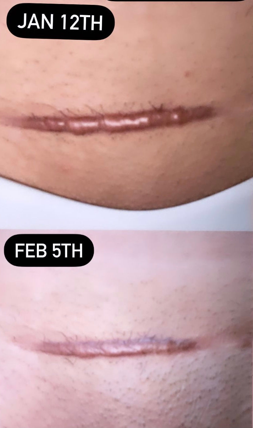 Thumbnail: Scar Tape (silicone)