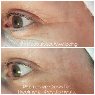 Soften crows feet with Plasma Pen