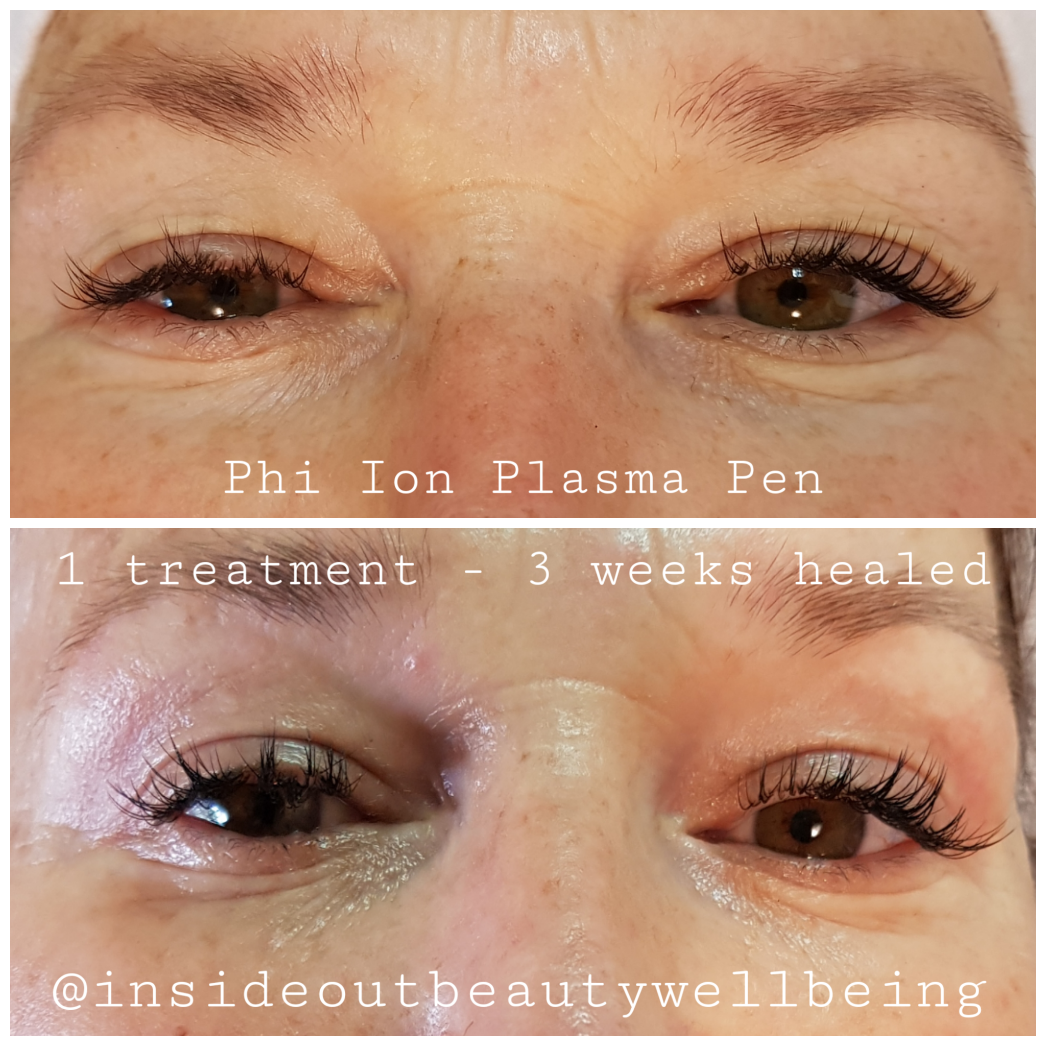 Plasma Pen Kerikeri www.insideoutbeauty.co.nz