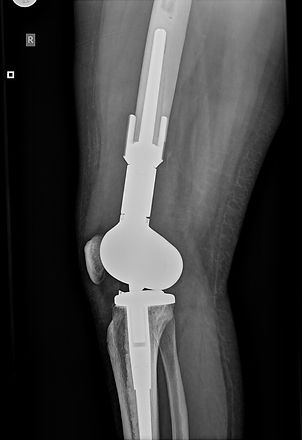 Distal Femur