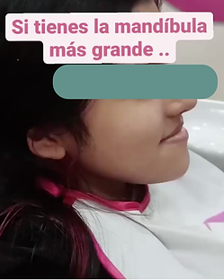 niña con mandibula salida o mas grande correccion de mala mordida ofm.png