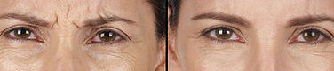 Before & After Photo Xeomin Neuromodulator Treatment Glabellar Lines | Before & After Photo Xeomin Neurotoxin Treatment Glabellar Lines | Before & After Photo Xeomin Wrinkle Relaxers Treatment Glabellar Lines