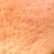 Texture_Scarring_Acne.jpg