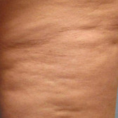 Skin Texture Scarring Acne Blemishes