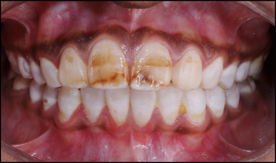 How We Treated Dental Fluorosis Without Drilling: A Smile Transformation at Netrayatan Dental Centre