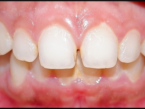 Smile makeover with Composite Veneers at Netrayatan Dental Centre