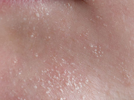 Corthe's Overnight Pimple Fix and Daily Acne Preventer