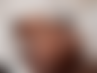 How to Treat Acne in Darker Skin Without Causing Hyperpigmentation