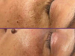 My Secret Weapon for That Glass-Skin Glow: The Plump + Glow Facial with Nano Mesotherapy