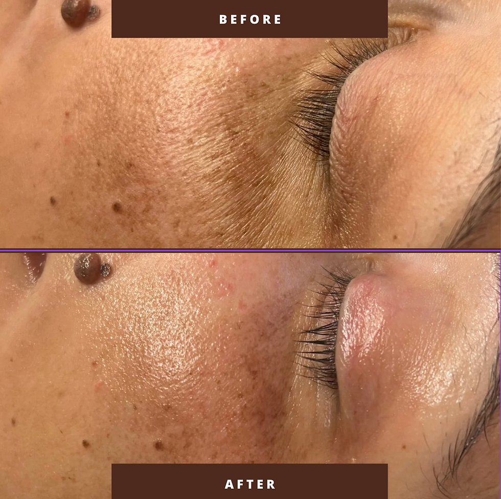 My Secret Weapon for That Glass-Skin Glow: The Plump + Glow Facial with Nano Mesotherapy
