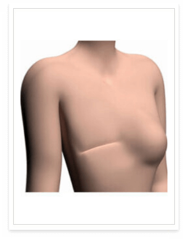 Thumbnail: Prosthetic breast kit