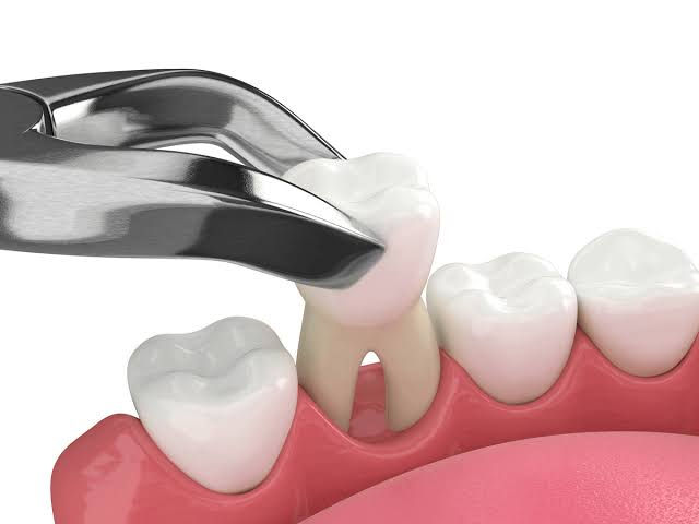 What to Expect During an Routine Dental Extraction