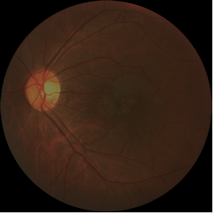 EVT NO APLICADA (MEMBRANA EPIRRETINIANA).png