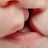 labio-leporino-orig-1.jpg