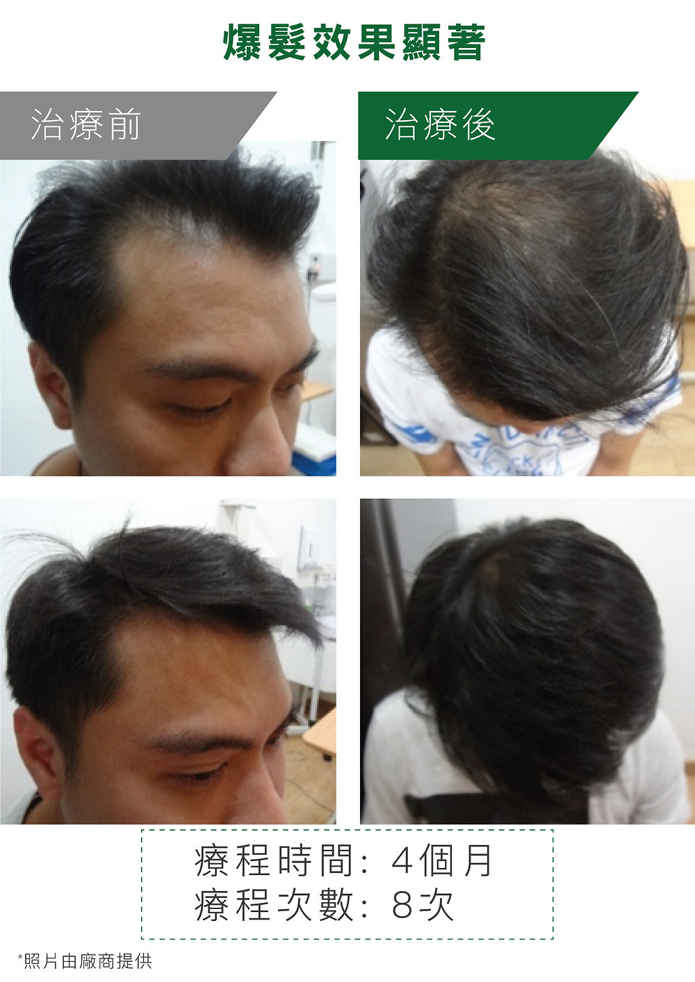 男士掉髮 治療效果