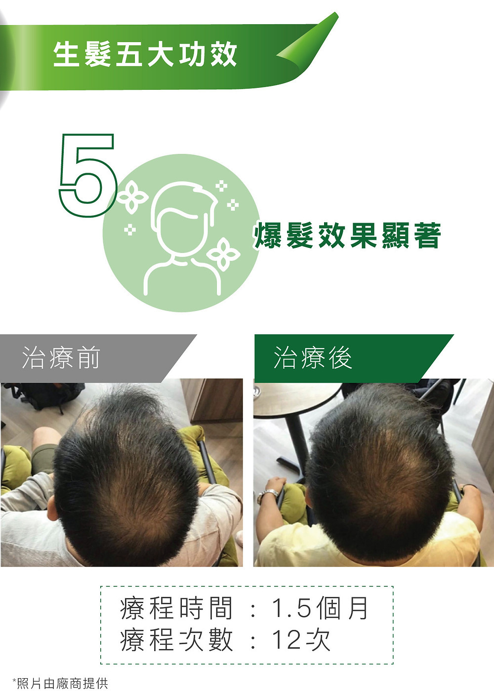 男士脫髮治療