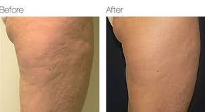 Radiofrequency For Cellulite Fat