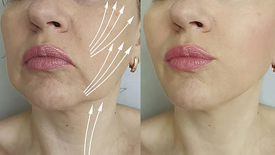 A professional placing PDO threads in the cheek area to restore volume and lift sagging skin.