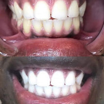 before and after teeth whitening syracuse ny