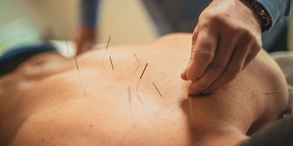 A person receiving NAET acupuncture for allergies