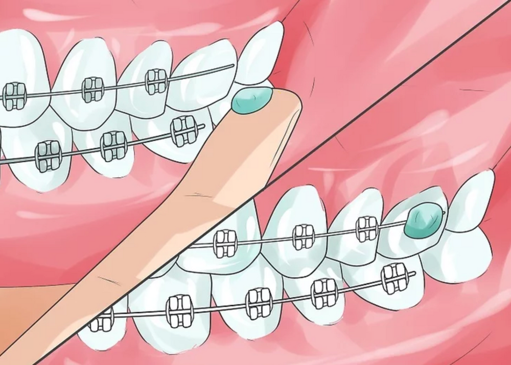 Wire or the bracket hurting.