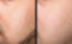 Exosome microneedling