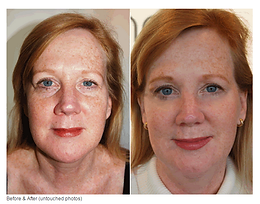 FaceLift Massage Somerville NJ
