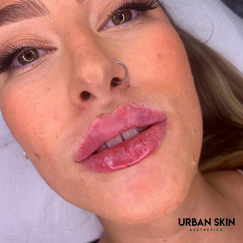 Lip Fillers Newcastle Urban Skin Aesthetics England