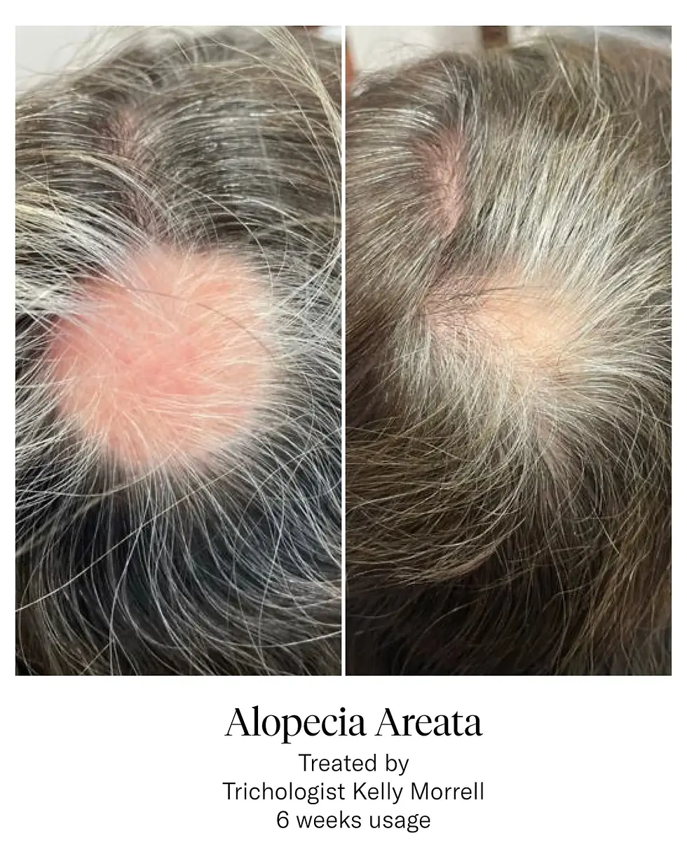 Thumbnail: Calecim Professional Advanced Hair System