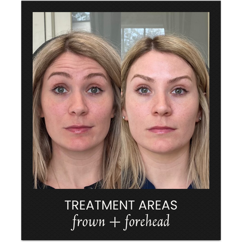 Botox cosmetic before and after treatment of SKNCRAFT client, treating frown and forehead for lines and wrinkles