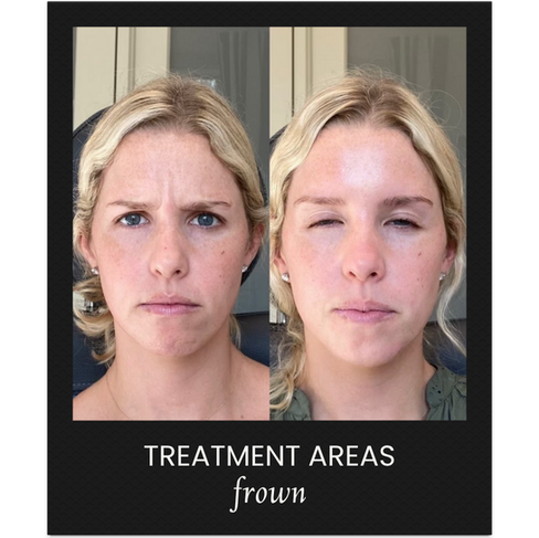 Before and After Photo Using Botox Cosmetic to treatment frown