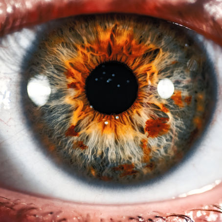 Intestinal Hyperactivity and Iridology
