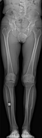 Arthrose pangonométrie