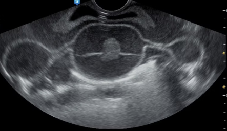 Reverberation artifact example image