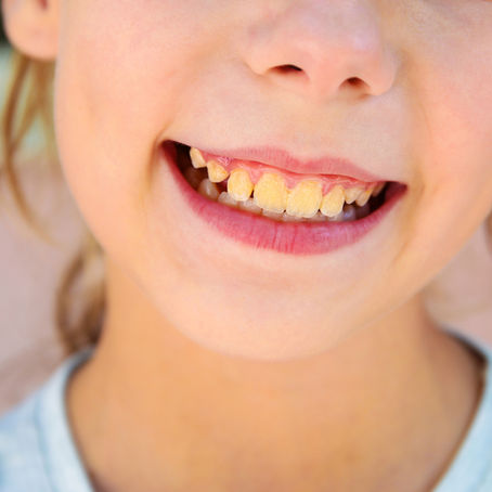 Why are my teeth yellow?