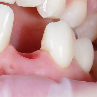 KNOCKED-OUT TOOTH (AVULSED TOOTH)