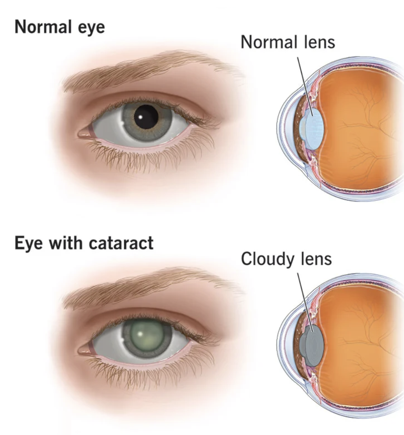 cataracts