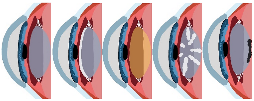 Different cataract types