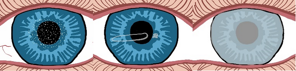 corneal dystrophies 4