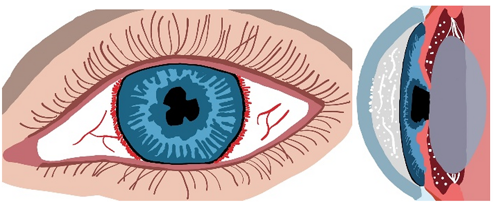Eye with anterior uveitis